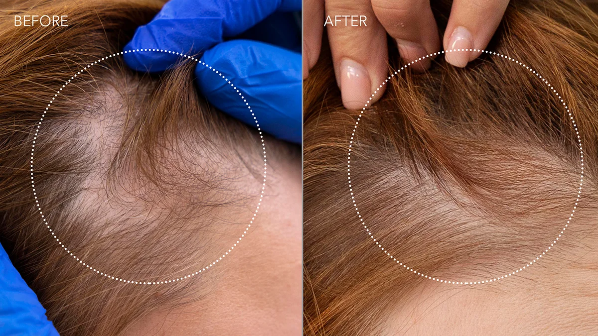 laser hair growth FAQ 302 before and after